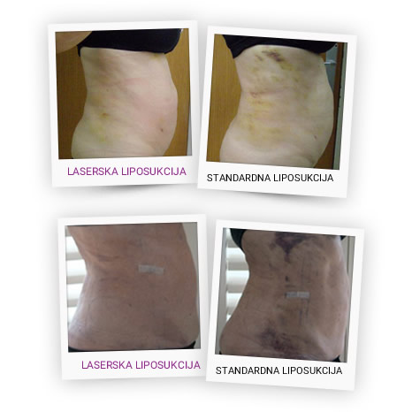 laserska vs standardna liposukcija - dr stanojlovic